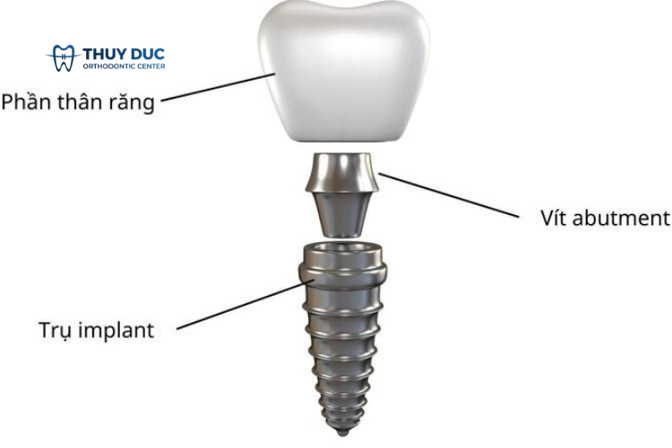 Abutment là gì? 1 Abutment là gì? 1