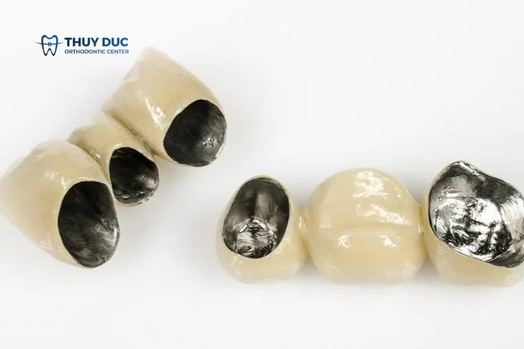 Bọc răng sứ Implant với răng sứ kim loại 1 Bọc răng sứ Implant với răng sứ kim loại 1