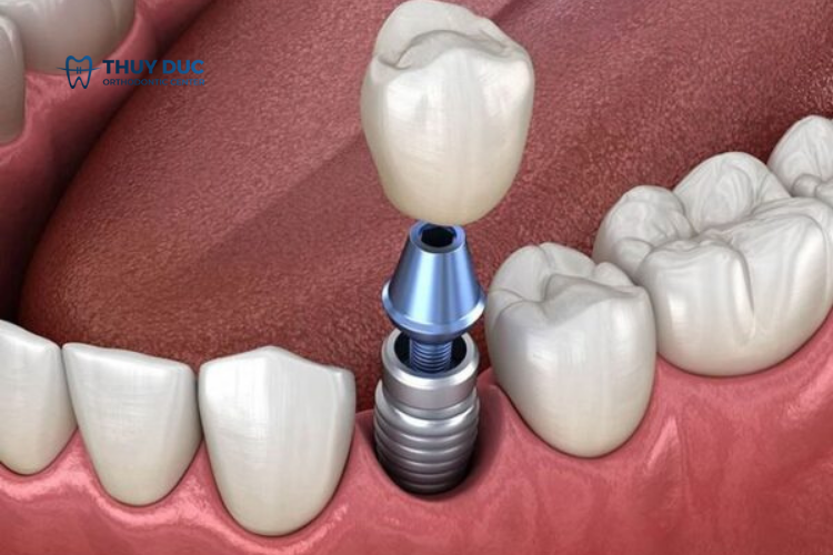 Bọc răng sứ implant là gì? 1 Bọc răng sứ implant là gì? 1