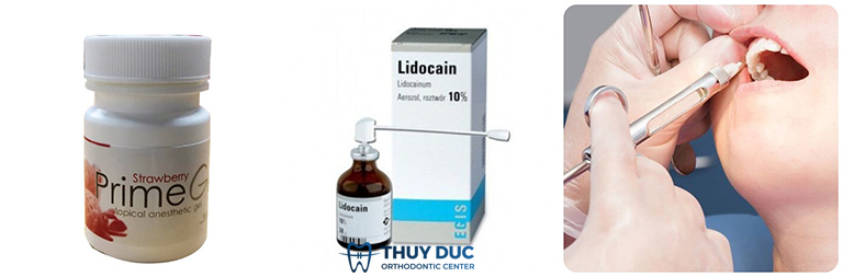 Tìm hiểu các loại thuốc tê khi nhổ răng khôn 1 Tìm hiểu các loại thuốc tê khi nhổ răng khôn 1