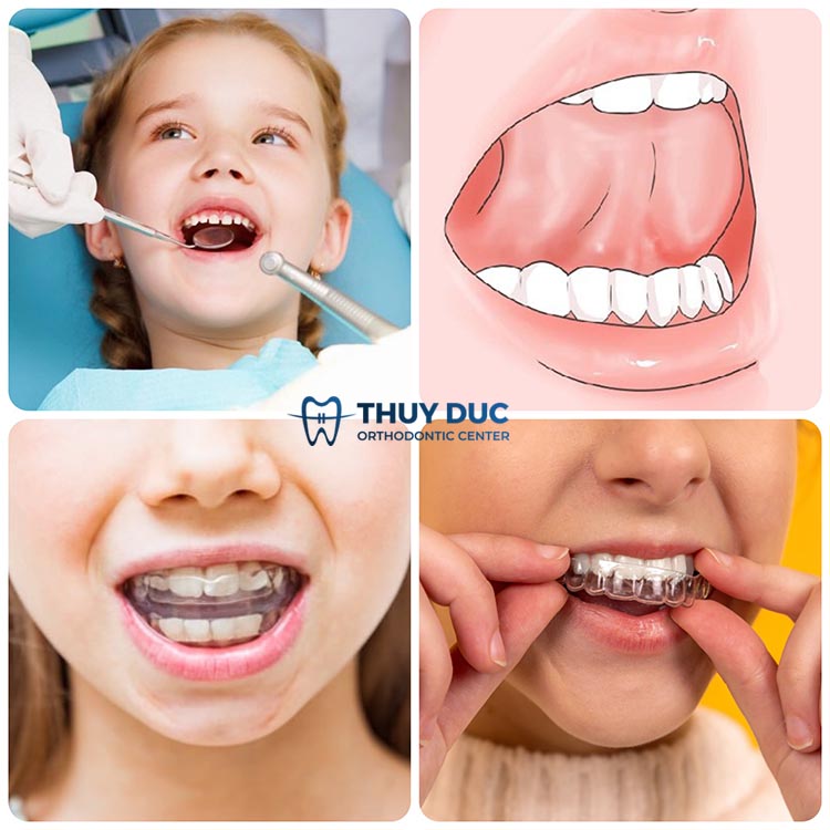 Cách xử lý tốt nhất mọc răng vĩnh viễn khi răng sữa chưa rụng 1 Cách xử lý tốt nhất mọc răng vĩnh viễn khi răng sữa chưa rụng 1