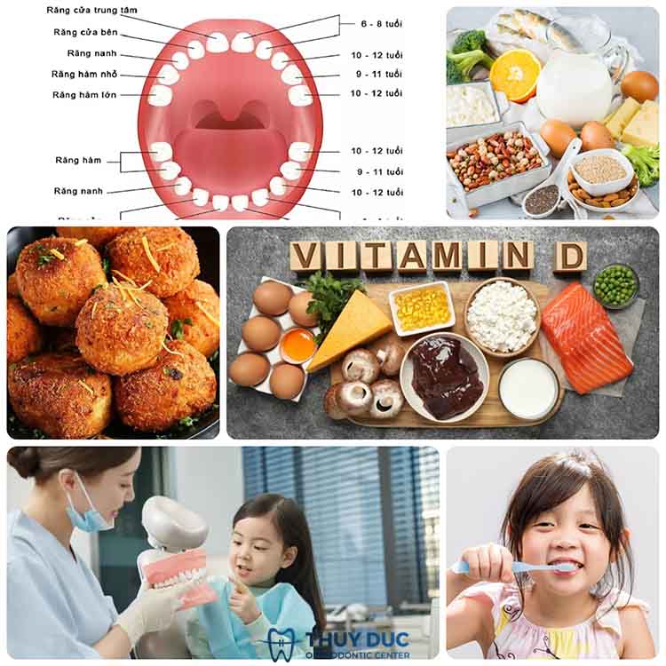 Cách phòng tránh mọc răng vĩnh viễn khi răng sữa chưa rụng 1 Cách phòng tránh mọc răng vĩnh viễn khi răng sữa chưa rụng 1