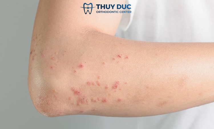 Dấu hiệu nhận biết dị ứng thuốc tê khi nhổ răng khôn 1 Dấu hiệu nhận biết dị ứng thuốc tê khi nhổ răng khôn 1