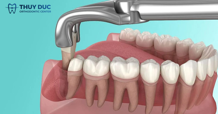 Nhổ răng khôn có được bảo hiểm chi trả không? 1 Nhổ răng khôn có được bảo hiểm chi trả không? 1