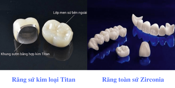 Chọn loại răng sứ phù hợp 1 Chọn loại răng sứ phù hợp 1
