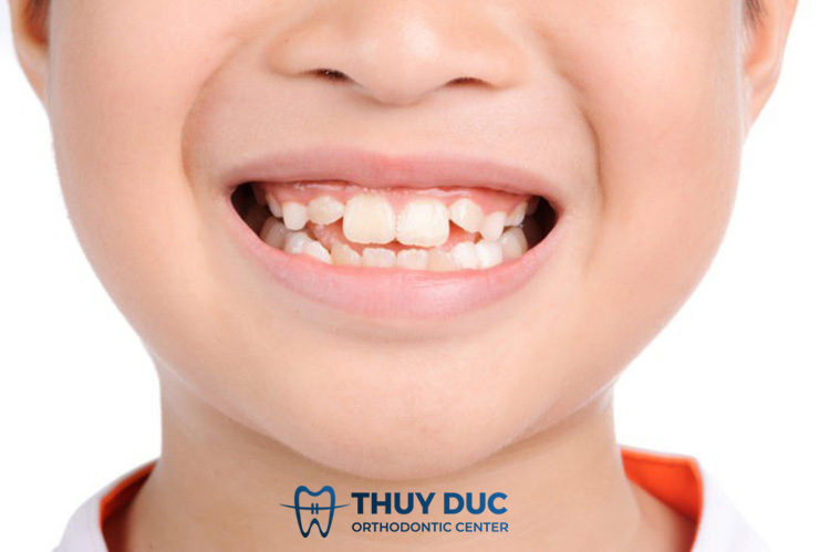 Mọc răng khi răng sữa chưa rụng có ảnh hưởng gì không? 1 Mọc răng khi răng sữa chưa rụng có ảnh hưởng gì không? 1