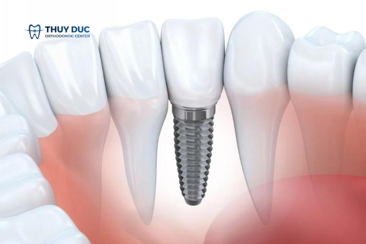 Khi nào cần sử dụng Abutment? 1 Khi nào cần sử dụng Abutment? 1
