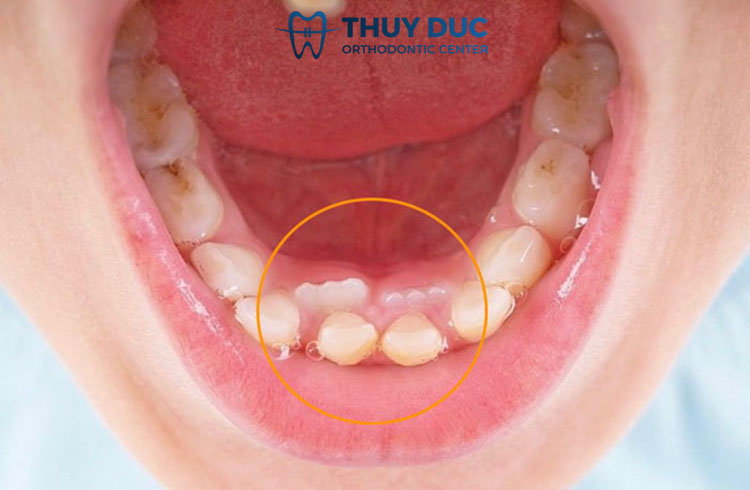 Vì sao răng vĩnh viễn mọc khi răng sữa chưa rụng? 1 Vì sao răng vĩnh viễn mọc khi răng sữa chưa rụng? 1