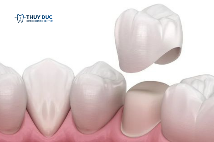 Các phương pháp chữa viêm tủy răng 1