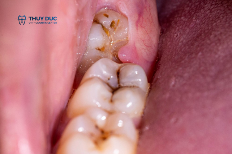 Nguyên nhân gây viêm tủy răng 1