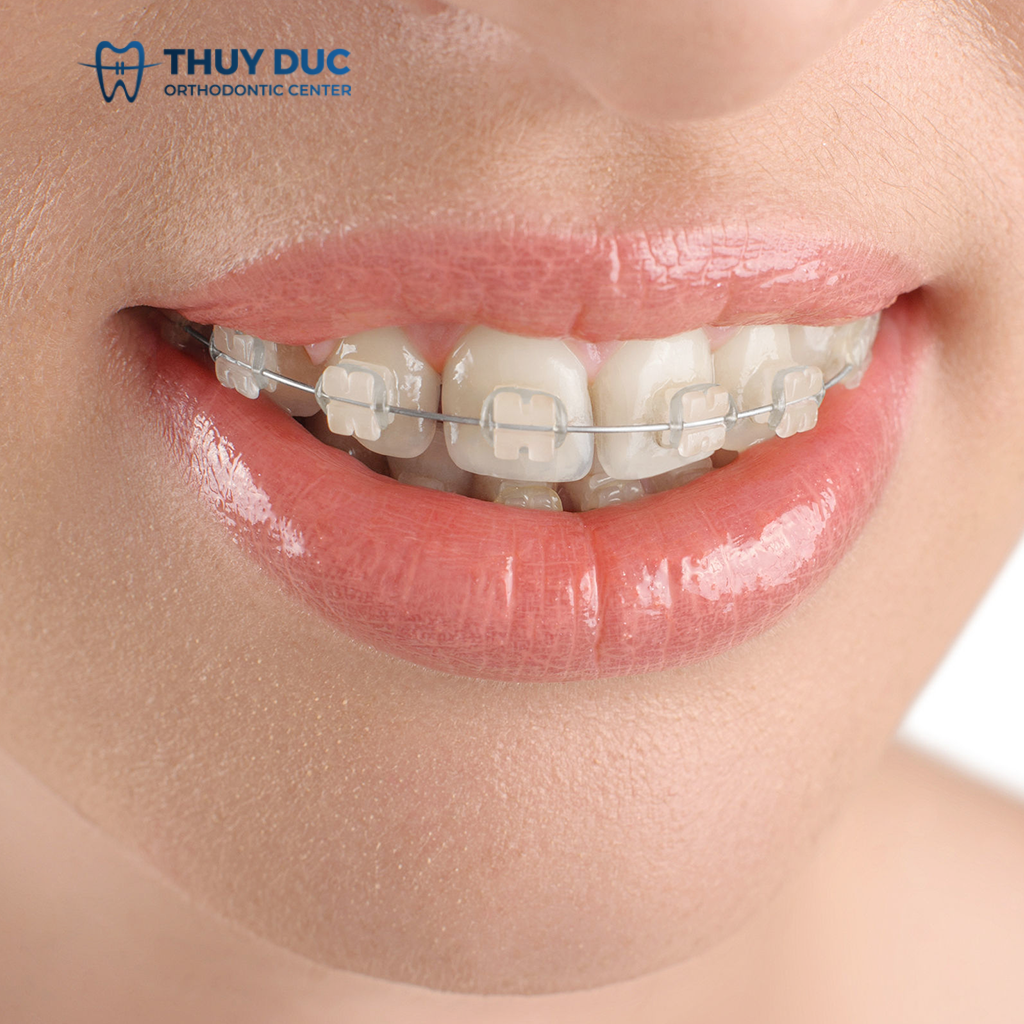 3. Nên niềng răng mắc cài pha lê, sứ hay kim loại? 1