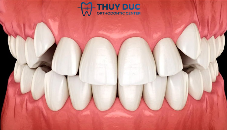 2. Niềng răng khểnh có cần nhổ răng không? 1