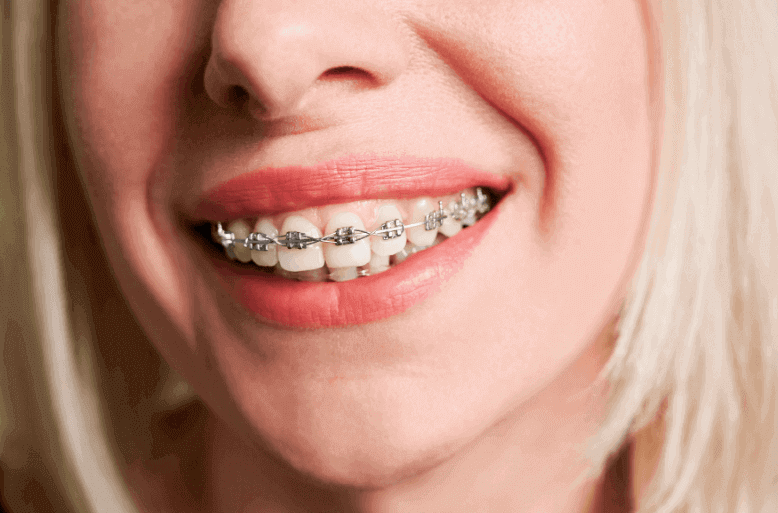 Niềng răng mắc cài kim loại 1