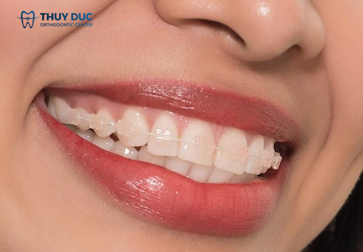 2. Niềng răng mắc cài pha lê bao nhiêu tiền? 1