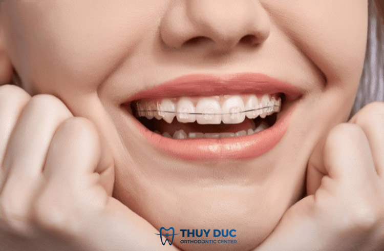 Niềng răng mắc cài pha lê chi phí bao nhiêu? 1