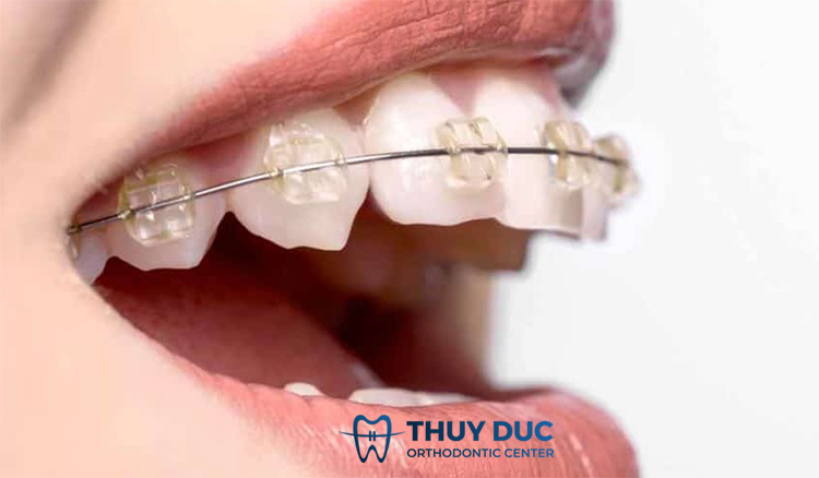 Niềng răng mắc cài sứ 1