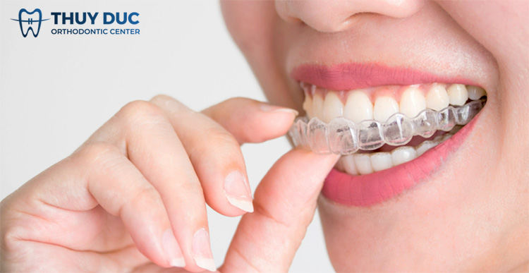 Niềng răng trong suốt Invisalign 1